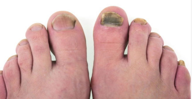 severe toenail fungus