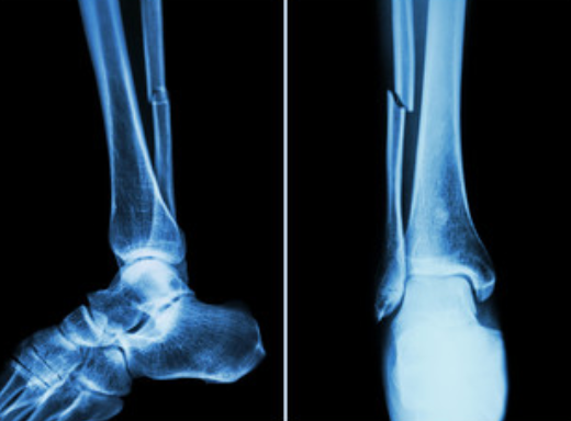 Ankle fractures