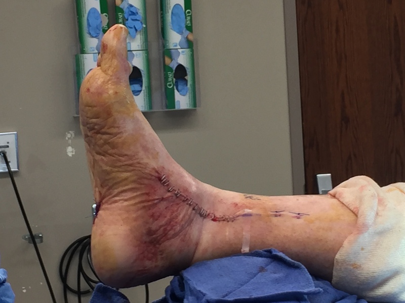 Foot after surgery