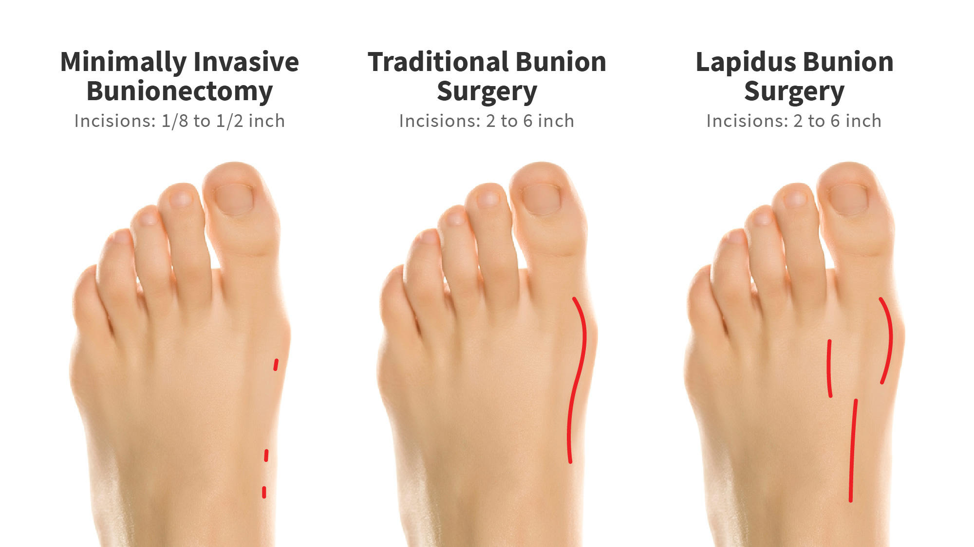 Minimally Invasive Surgery  Arkansas Foot & Ankle Specialists